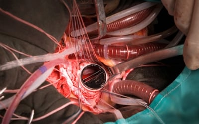 valve heart replacement am