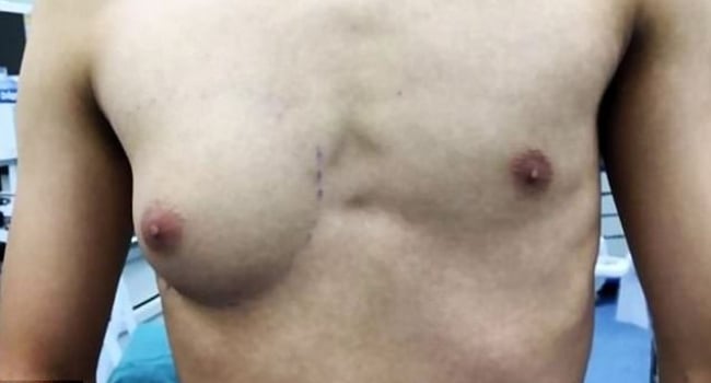 Teenage boy grows a single A-cup breast on his chest and doctors think  fastfood could be to blame