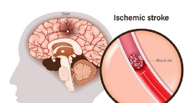 Post-Stroke Rehabilitation to Meet International Standards: Certification ...