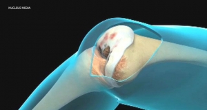 Total knee replacement: what you need to know