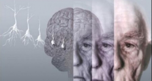 5 интересных фактов о болезни Альцгеймера