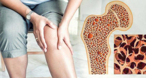 В Армении ежегодно фиксируется порядка 3 тысяч переломов, обусловленных остеопорозом