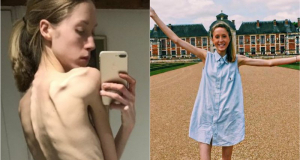 Чуть не умершая из-за анорексии девушка ведет блог о выздоровлении