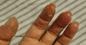 Гель-лак для ногтей может вызывать сильные аллергические реакции