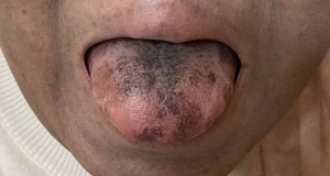 Patient's tongue turns 'black and hairy' because of rare reaction to a common antibiotic