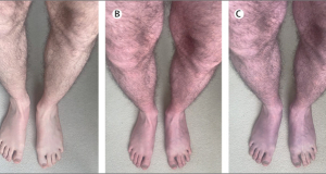 Исследователи рассказали о симптоме «синих ног» у пациента с длительным течением COVID-19
