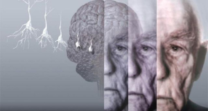 Researchers identify two main pathways involved in Alzheimer's disease