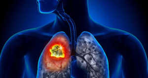 Գիտնականները ԱԲ օգնությամբ գնահատել են չծխող մարդկանց թոքերի քաղցկեղի առաջացման վտանգը