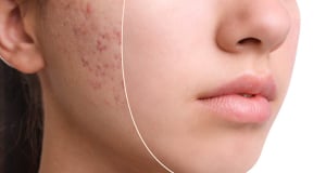 Diets are pointless in case of acne, dermatologist says
