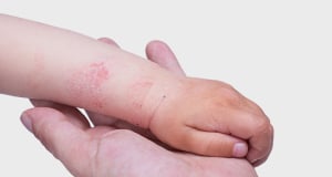Researchers find increased risk of memory problems in children with eczema