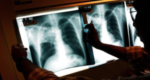 Tuberculosis cases down by about 62% in Armenia in past 10 years, specialist says