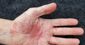 Nature Communications: Psoriasis is caused by gene mutations, study finds