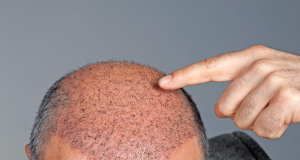 Հայ տղամարդիկ ավելի հաճախ են սկսել դիմել մազերի փոխպատվաստման. պլաստիկ վիրաբույժ