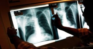 Эксперты разрабатывают новую иммунотерапию для борьбы с туберкулезом