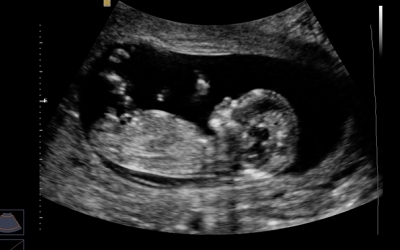 normal heartbeat for 12 week fetus