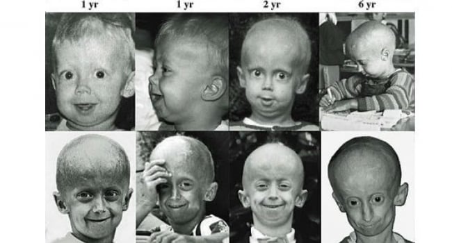 Hutchinson Gilford Progeria Syndrome Life Expectancy