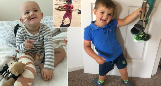 Շրջված ոտք. 3 տարեկան  տղան եզակի վիրահատության է ենթարկվել (ֆոտո)