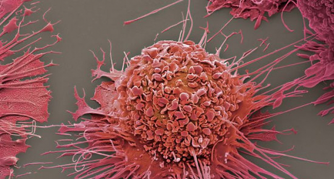 Քաղցկեղի ո՞ր տեսակներն են  հաջողությամբ բուժվում