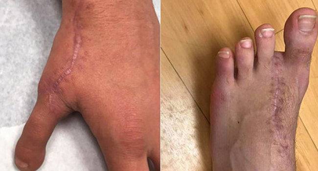 Բժիշկները ոտքի ցուցամատը կարել են ձեռքի բութ մատի փոխարեն