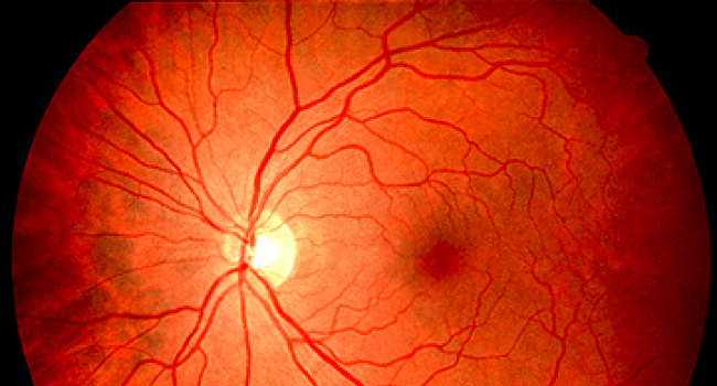 Норма глазного дна. Офтальмоскопия глазного дна норма. Интрабульбарный неврит. Ретробульбарный неврит зрительного нерва. Ретробульбарный неврит зрительного нерва глазное дно.