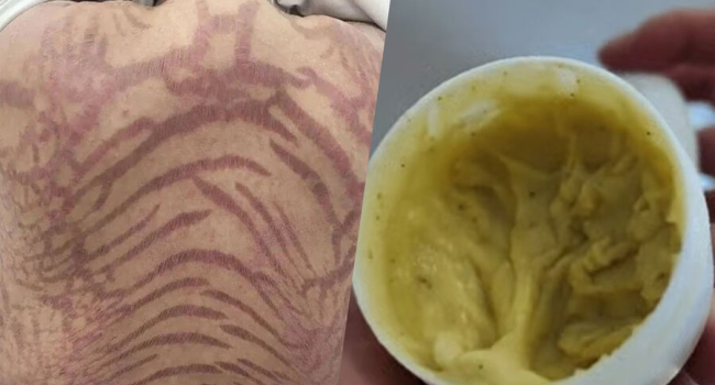 Snake Skin Rash SCMP: Chinese Woman Develops Snake-Like Skin Patterns After 10 Years of ...