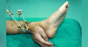 Doctors grafted man's injured hand to his ankle