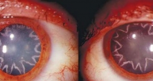 A man obtained a star-shaped cataract after electrical burn