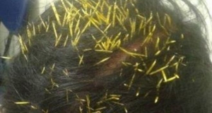 200 quills of porcupine are pulled out from the head of a Brazilian woman