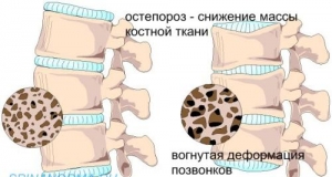 Остеопороз &ndash; болезнь современности