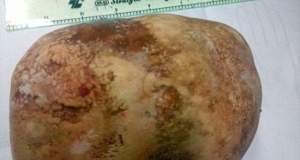 Man has six-INCH bladder stone removed after suffering agonising pain for 10 years