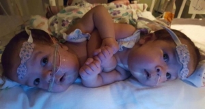 Врачи разделили 5-месячных сиамских близнецов-девочек с помощью 3D печати