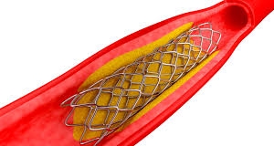 С 2015 года в рамках программы Stent for Life неотложное стентирование сделано 3000 пациентам