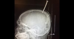 Boy's skull pierced with screw in treehouse-building accident