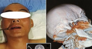 Վիրաբույժները փրկել են գանգի մեջ մետաղական ձողով տղային