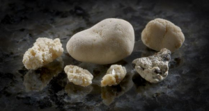 Kidney stones have distinct geological histories: study