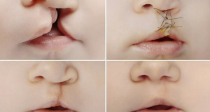 Breakthrough for babies with cleft palates as scientists claim umbilical cord blood could be used to repair the common facial defect