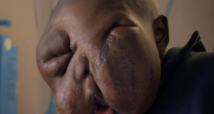 Incredible before and after pictures of cancer-stricken teenager whose facial tumour grew so big his own MOTHER disowned him