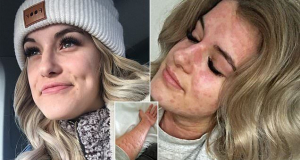 The woman allergic to winter: 21-year-old suffers rare condition which can trigger anaphylactic shocks if she gets cold (and worryingly she lives in Canada)