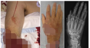Man, 67, has his arm RESEWN after he accidentally cut it off