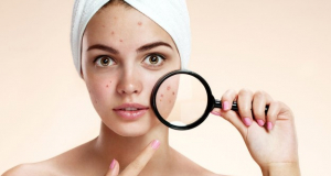 Genome-wide meta-analysis implicates mediators of hair follicle development and morphogenesis in risk for severe acne