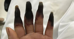 Eight of woman’s fingers have 'decayed' and turned BLACK after she left a cut untreated