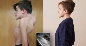 Boy with severe scoliosis stands tall after life-changing surgery