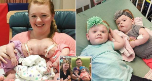 Twins formerly conjoined at the BRAIN are thriving a year-and-a-half after groundbreaking separation