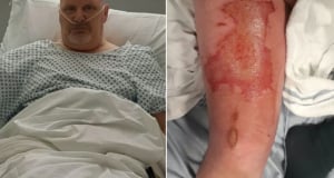 Man says vape pen left him with third-degree burns after pocket explosion