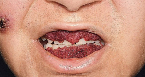 Doctors stunned by woman's rare disease that made her gums look like strawberries