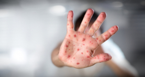 New measles surveillance data for 2019