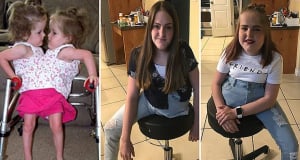 Conjoined twins born fused at the abdomen who now have one leg EACH after separation surgery are thriving at 17 and 'feel the same as everybody else'