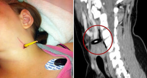 Girl, 11, rushed to hospital with a pencil hanging out of her neck after 'landing on the sharpened side when she fell during a break at school'