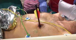 Man walks into hospital with arrow through heart, somehow survives