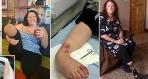 Женщина попросила врачей удалить ее ногу после необычной травмы, перевернувшей ее жизнь